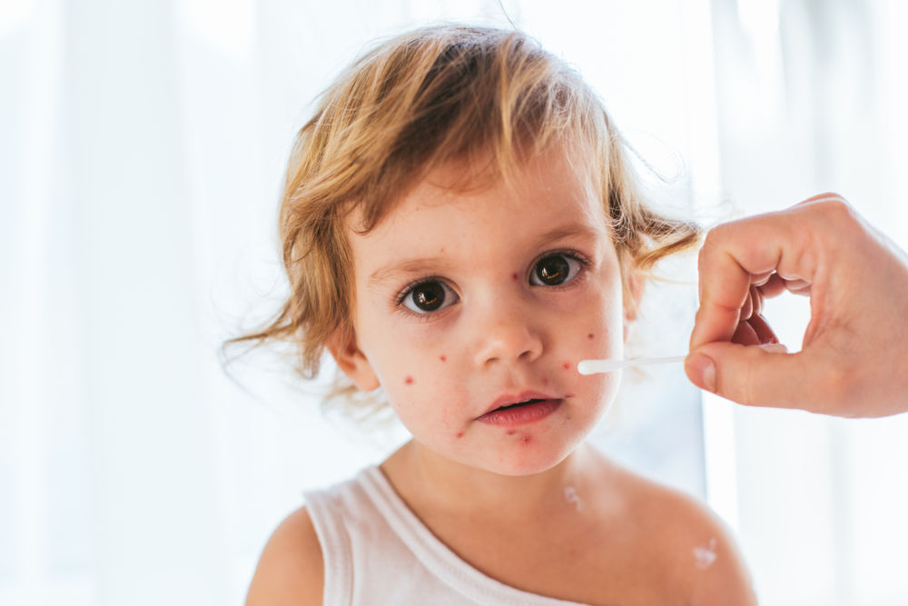 Лечение стрептодермии у ребенка: эффективные препараты, мази